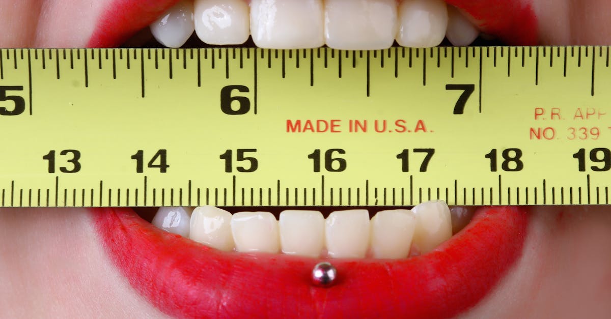 Are full mouth dental implants worth it?