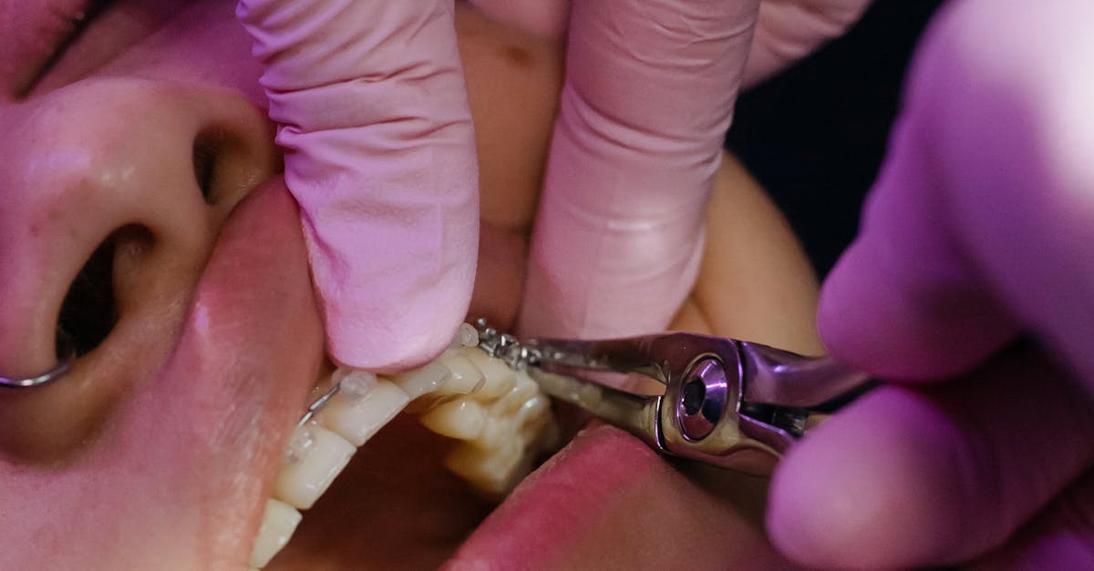 Are teeth implants safe in Turkey?