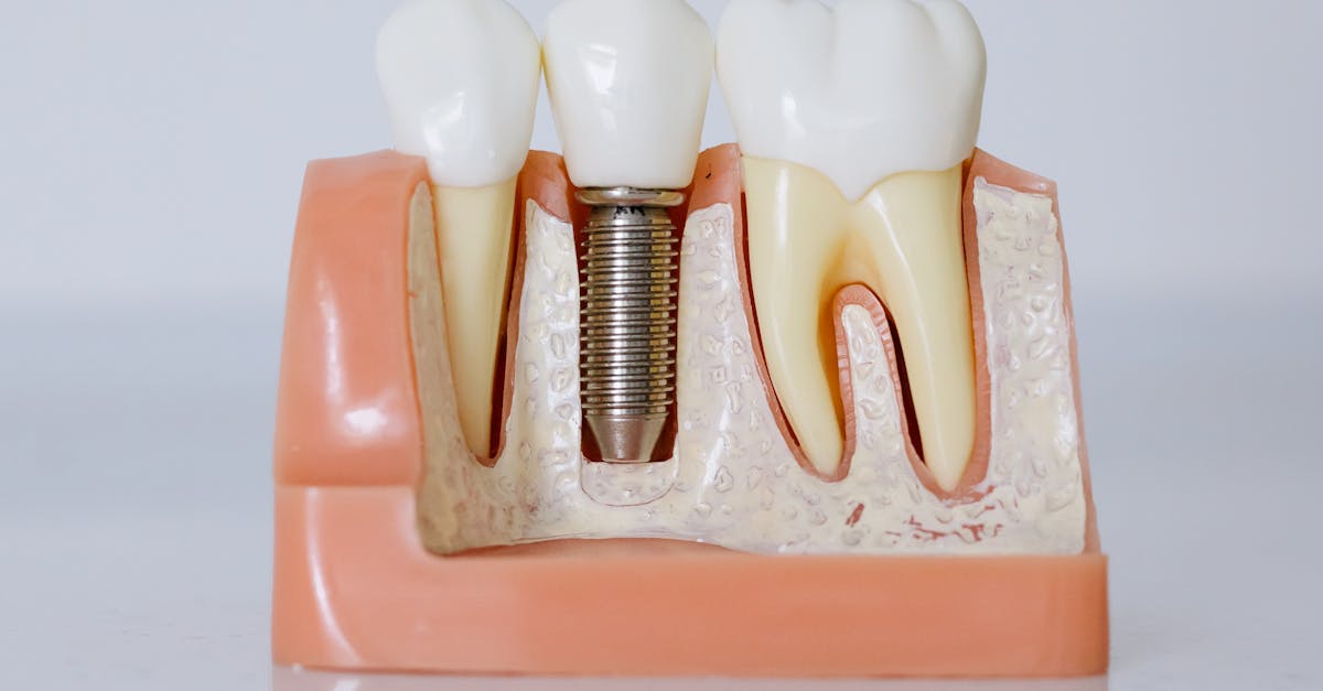 Can a tooth implant be done in a day?