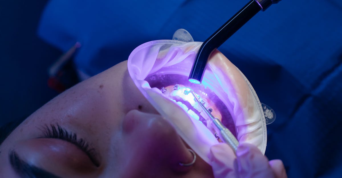 Can full mouth implants be done in one day?