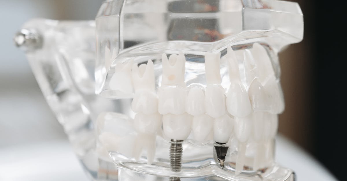 Can you pay monthly for teeth implants?