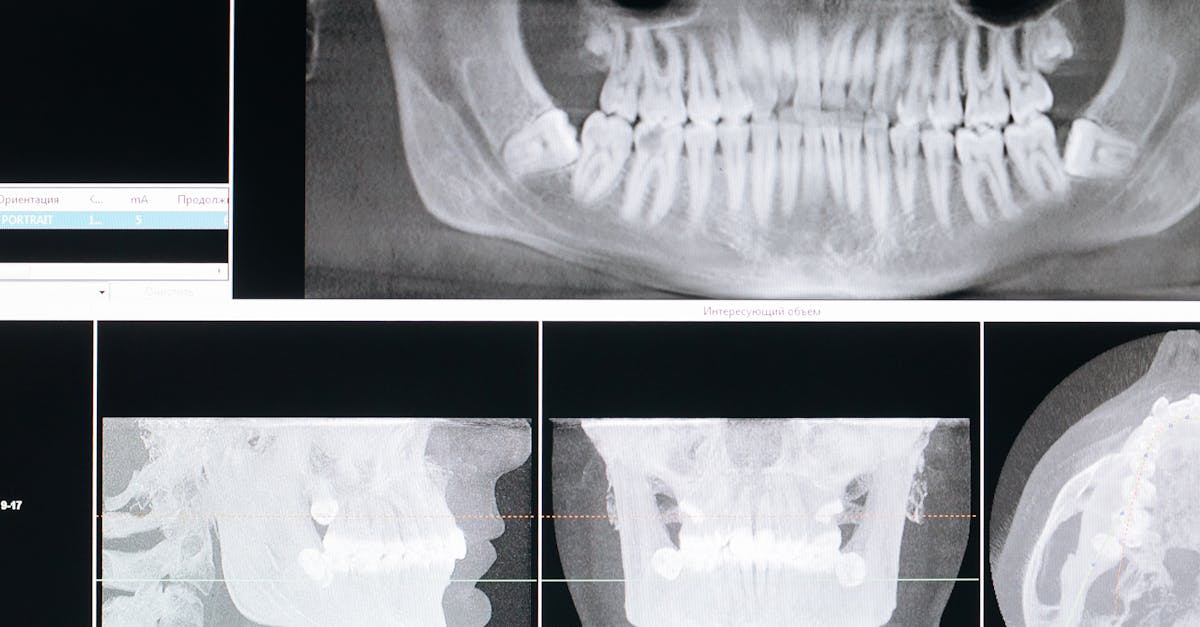 How long do Turkey teeth last?