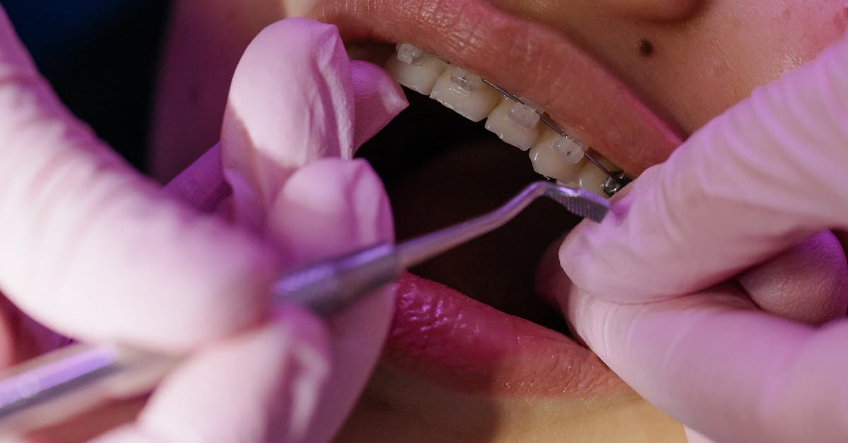 How much does it cost to get a full mouth of dental implants in Turkey?