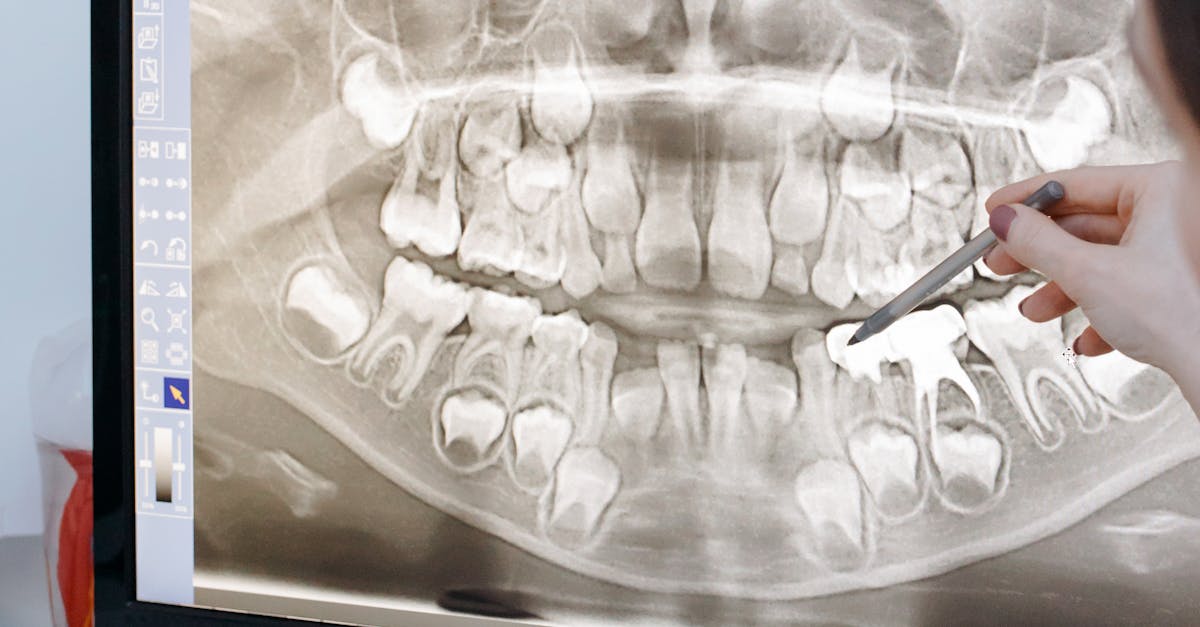 How much is a full mouth of dental implants in Turkey?